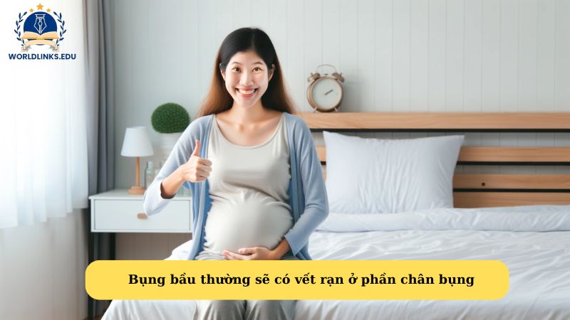 Bụng bầu thường sẽ có vết rạn ở phần chân bụng